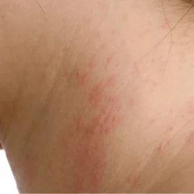 Eczéma