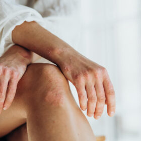 Psoriasis